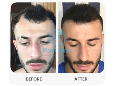Before & After Result