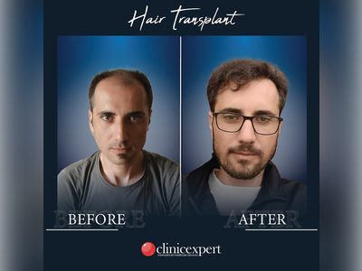 Before & After Result