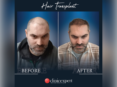 Before & After Result