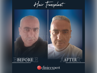 Before & After Result