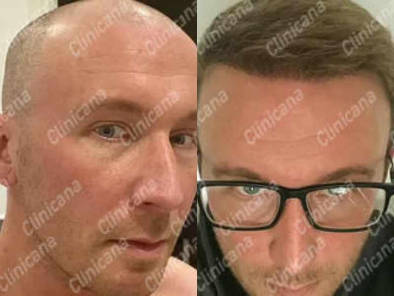 Before & After Result