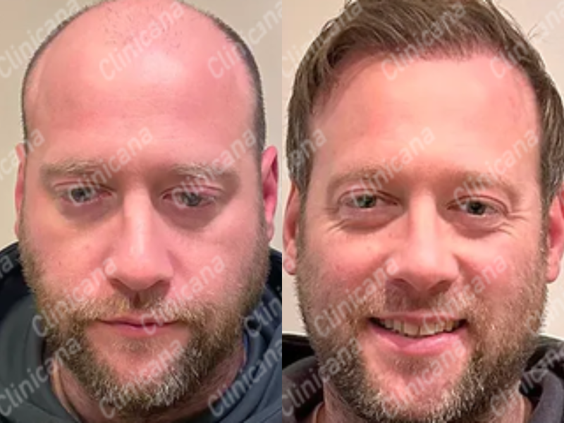 Before & After Result