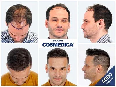Before & After Result