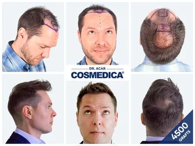 Before & After Result