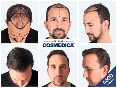 Before & After Result