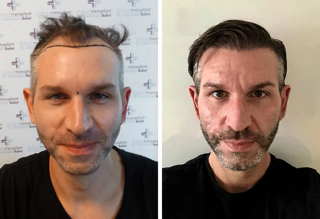 Before & After Result