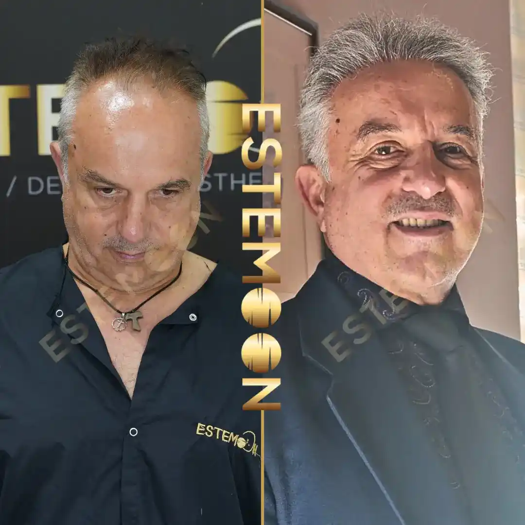 Before & After Result