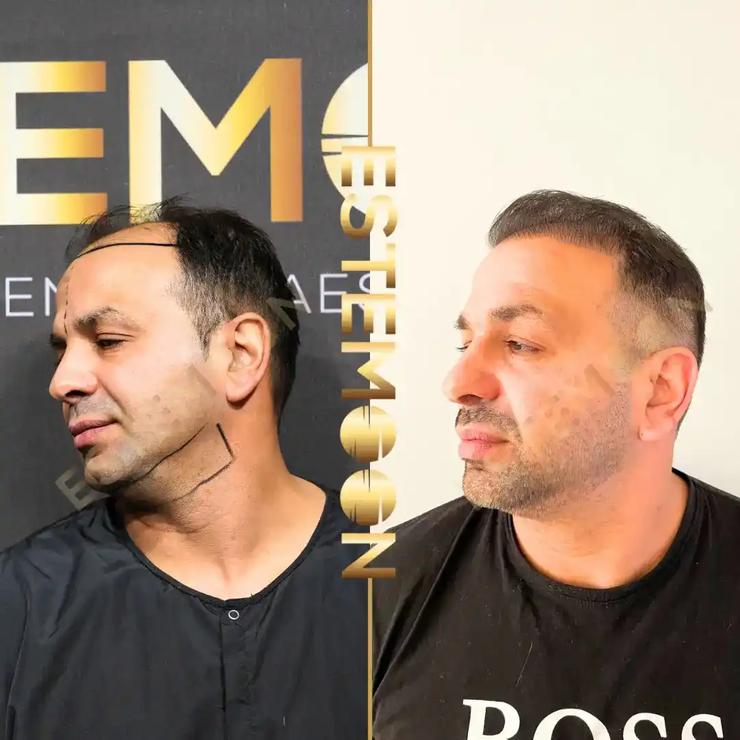 Before & After Result