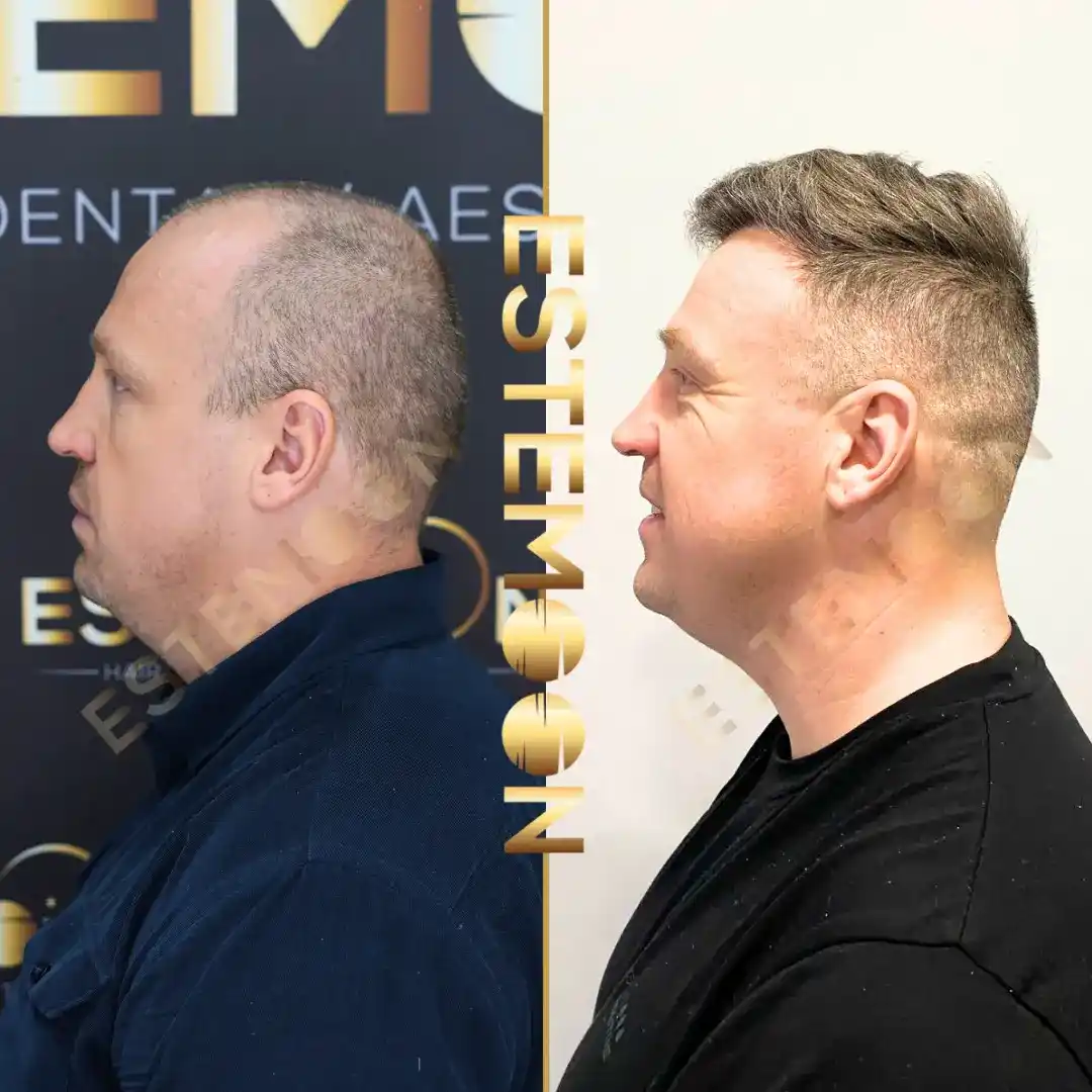 Before & After Result