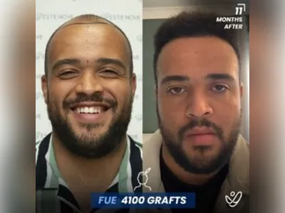 Before & After Result