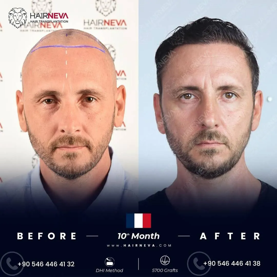 Before & After Result
