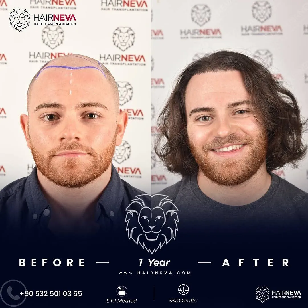 Before & After Result