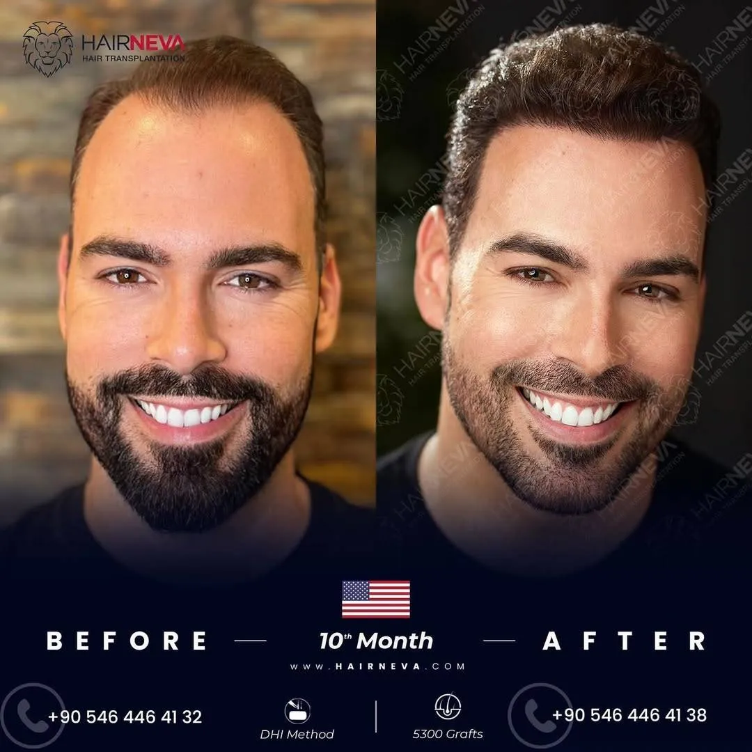 Before & After Result