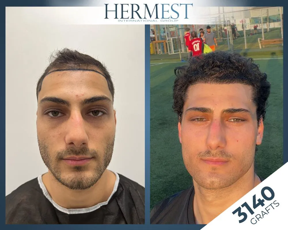 Before & After Result