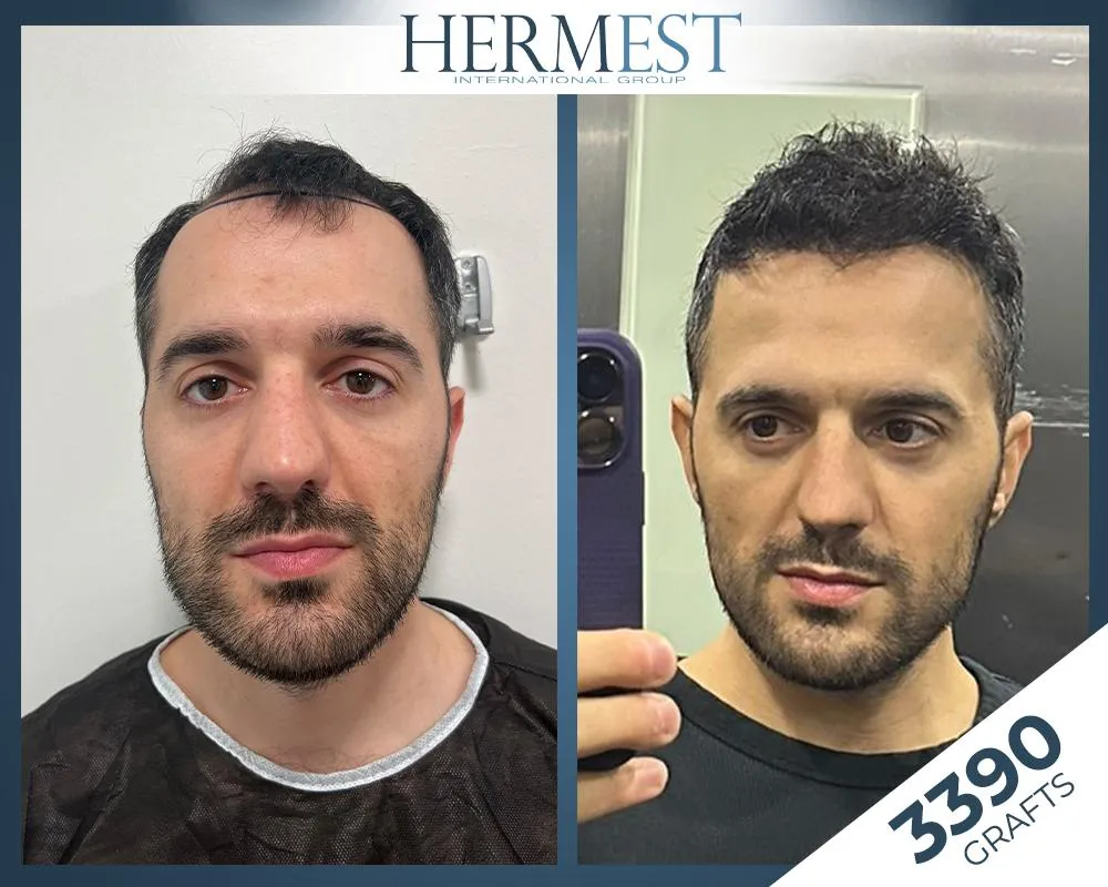 Before & After Result