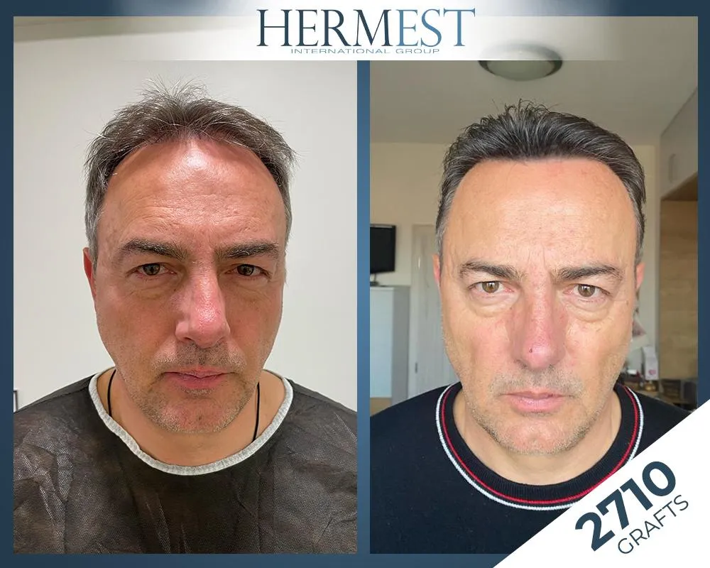 Before & After Result