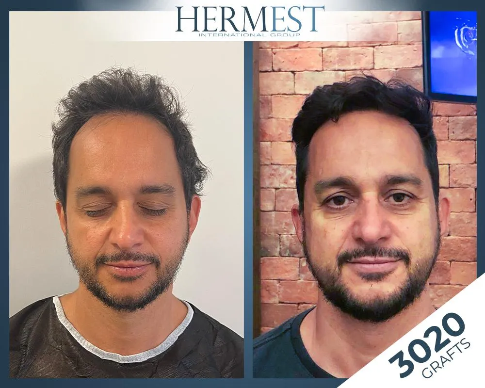 Before & After Result