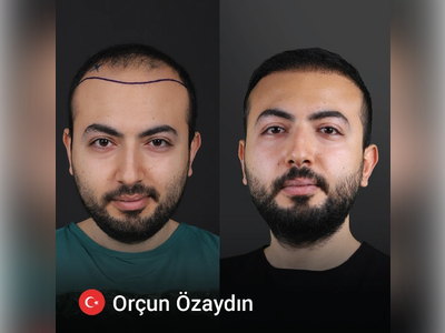 Before & After Result