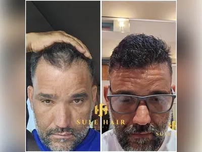 Before & After Result