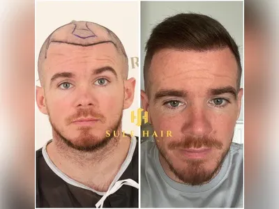 Before & After Result