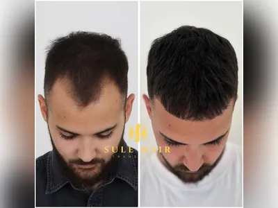 Before & After Result