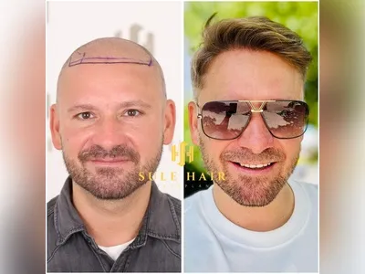 Before & After Result