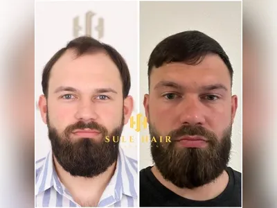 Before & After Result